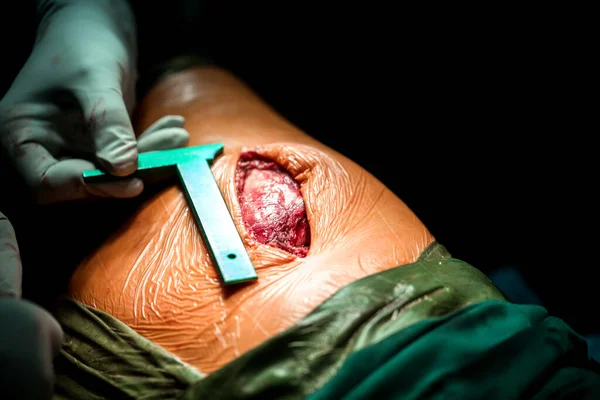 Zooming Closeup Macro View Ulcerative Infected Wound Surgical Irrigation Size — Stock Photo, Image