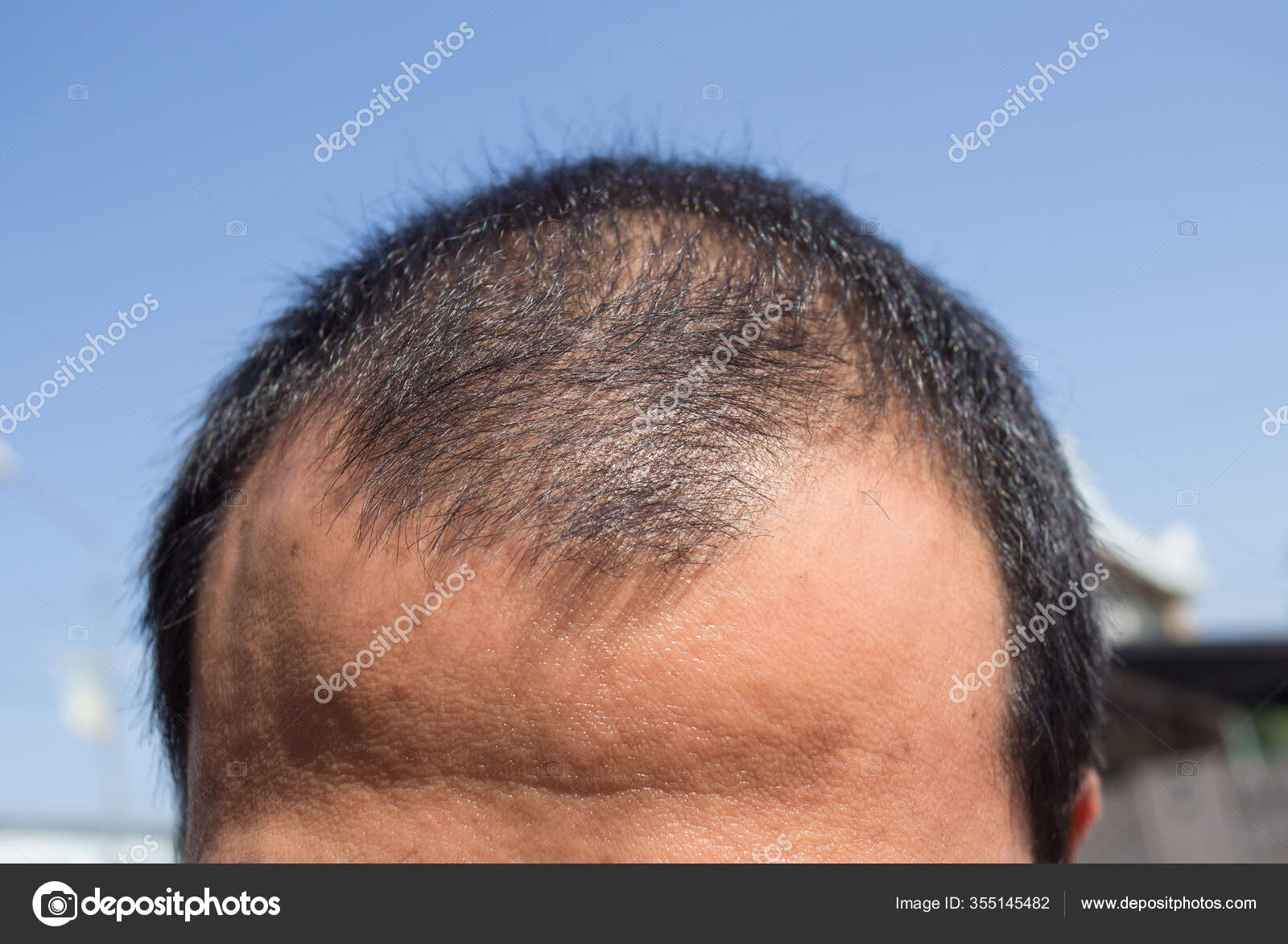 Middle Aged Man Concerned Hair Loss Baldness Hair Loss Concept Stock Photo by ©ganchaonan1@ 355145482 Middle Aged Man Concerned Hair Loss Baldness Hair Loss Concept Stock Photo by ©ganchaonan1@ 355145482