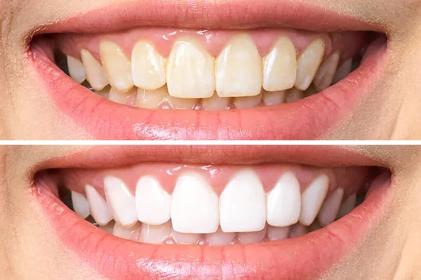 Kobieta zębów przed i po wybielania. na tle — Zdjęcie stockowe