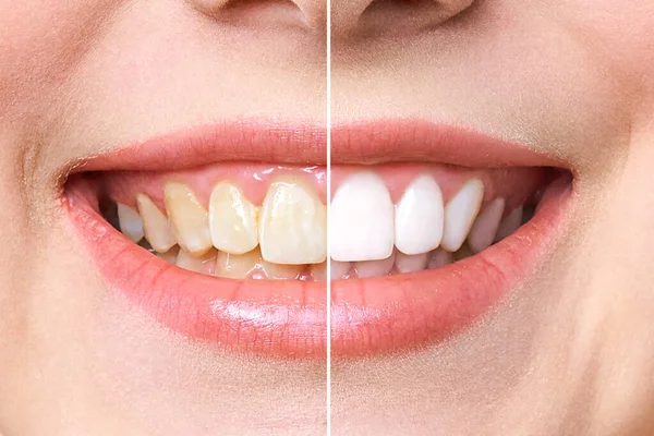 Woman teeth before and after whitening. Over white background. Dental clinic patient. Image symbolizes oral care dentistry, stomatology — Stock Photo, Image