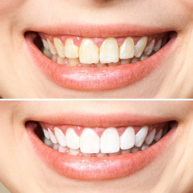 woman teeth before and after whitening. Over white background. Dental clinic patient. Image symbolizes oral care dentistry, stomatology clipart