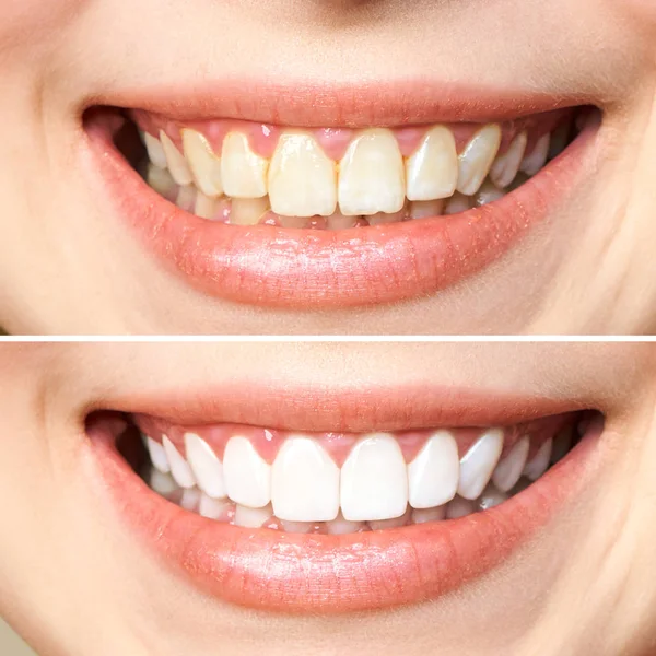Női fogak fehérítés előtt és után. Fehér háttérrel. Fogorvosi beteg. Kép szimbolizálja szájápolás fogászat, fogtechnika — Stock Fotó