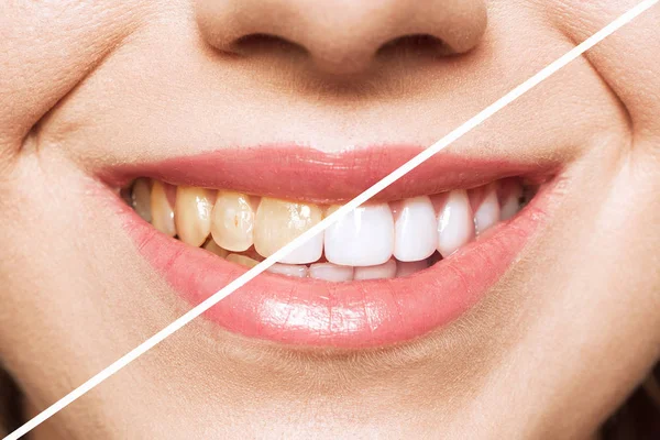 Dientes de mujer antes y después del blanqueamiento. Sobre fondo blanco. Paciente de la clínica dental. La imagen simboliza el cuidado bucal odontología, estomatología — Foto de Stock