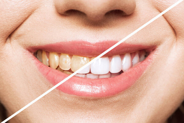 woman teeth before and after whitening. Over white background. Dental clinic patient. Image symbolizes oral care dentistry, stomatology