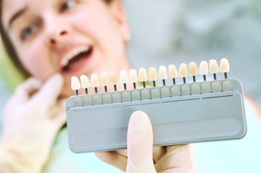 Beautiful smile and white teeth of a young woman. Matching the shades of the implants or the process of teeth whitening. Teeth palette.