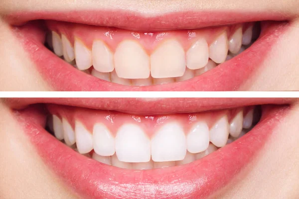 Woman teeth before and after whitening. Over white background. Dental clinic patient. Image symbolizes oral care dentistry, stomatology — Stock Photo, Image