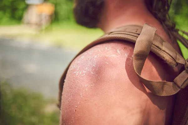Mężczyzna turysta nie używał kremu do opalania i otrzymał oparzenie słoneczne. — Zdjęcie stockowe