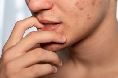 Sivilceli suratlı bir genç tırnaklarını yiyor.