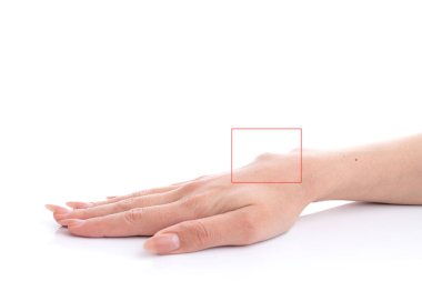 Ganglion cyst on woman hand circled in red square isolated on white background clipart
