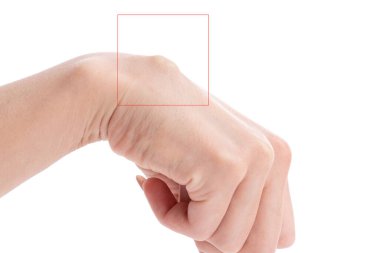 Females hand with big cyst hygroma circled in red square isolated on white clipart
