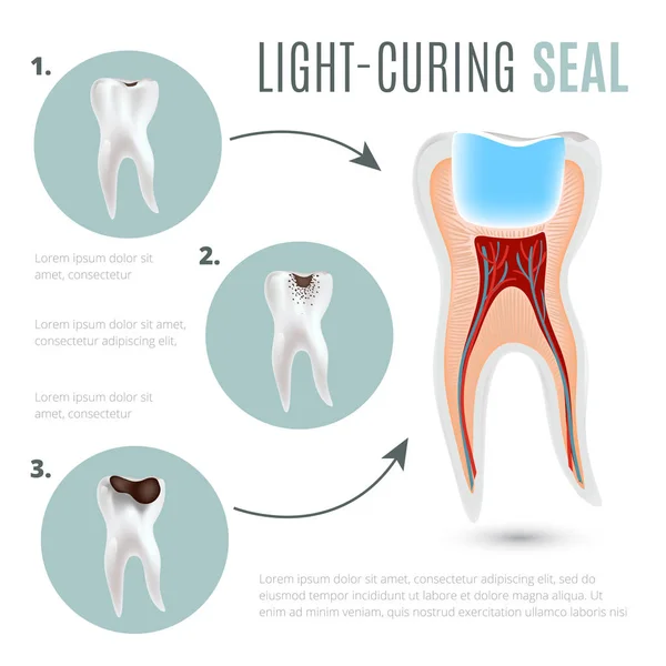 Poster medis yang realistis dengan tahapan pembusukan gigi dan segel yang dapat menyembuhkan cahaya - Stok Vektor