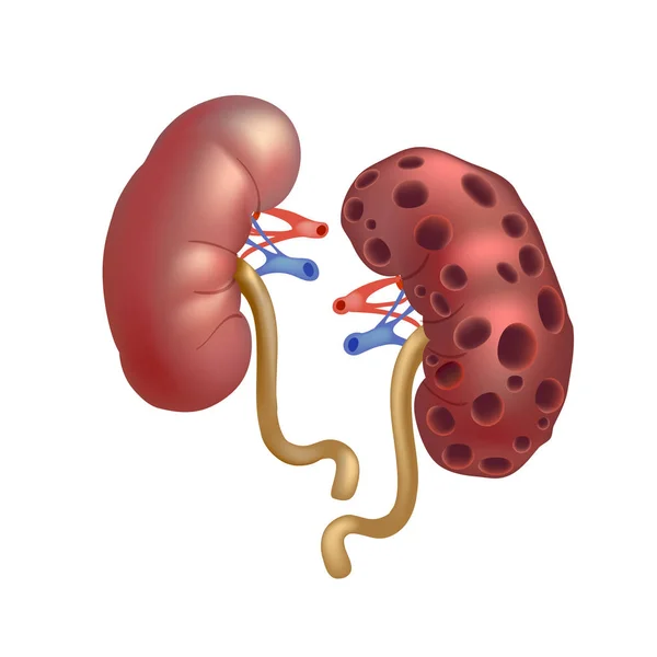 Realistiska mänskliga sjuka njurar isolerad på vit bakgrund. — Stock vektor