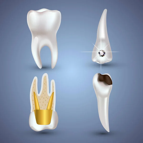 Conjunto vectorial de dientes limpios y sucios realistas 3d aislados sobre fondo gris. Concepto de salud dental. Cuidado bucal, restauración dental — Vector de stock