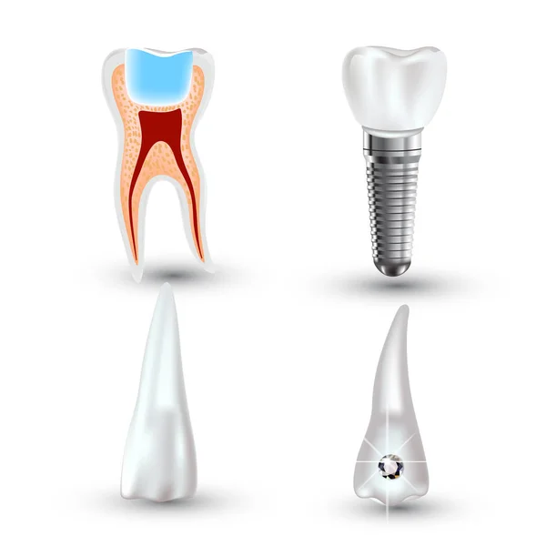 Conjunto vetorial de dente limpo e sujo 3d realista isolado no fundo branco. Dental health Concept. Cuidados bucais, restauração dos dentes — Vetor de Stock