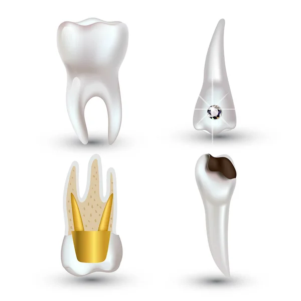 Conjunto vectorial de dientes limpios y sucios realistas 3d aislados sobre fondo blanco. Concepto de salud dental. Cuidado bucal, restauración dental — Archivo Imágenes Vectoriales