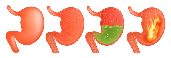 Векторная медицинская иллюстрация реалистичного желудка снаружи и внутри. Гастрит и кислотный рефлюкс, расстройства пищеварения и боли в желудке . — стоковый вектор