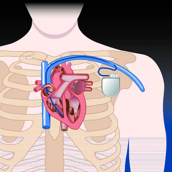 Schema Schematico Del Pacemaker Gli Elementi Sono Uno Strato Separato — Vettoriale Stock