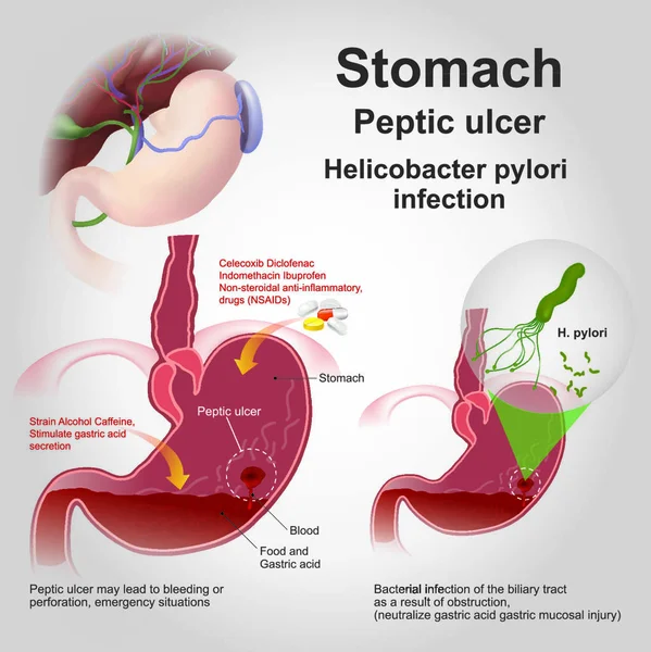 Eptic Ulcer Disease Also Known Peptic Ulcer Stomach Ulcer Break — Stock Vector
