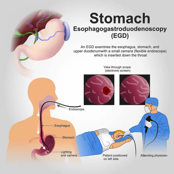 Esophagogastroduodenoscopy Also Called Various Other Names Diagnostic Endoscopic Procedure Visualizes — Stock Vector