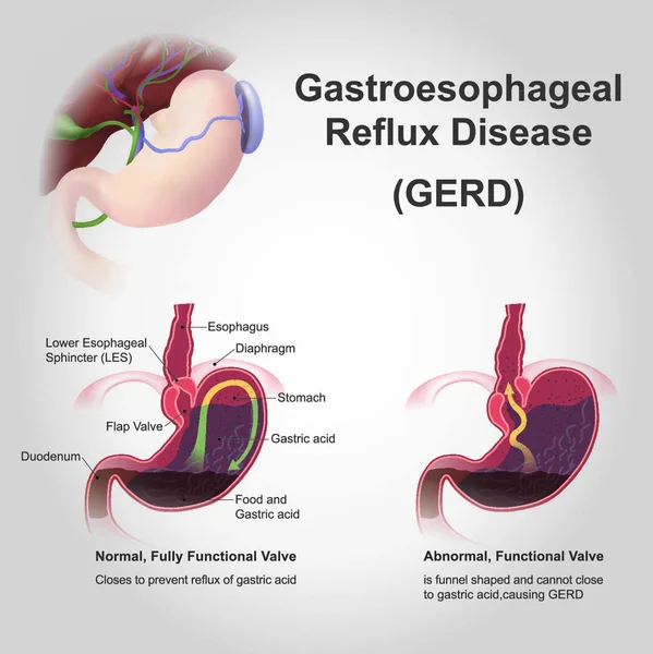 Gastroesophageal Reflux Disease Gerd Also Known Acid Reflux Long Term — Stock Vector