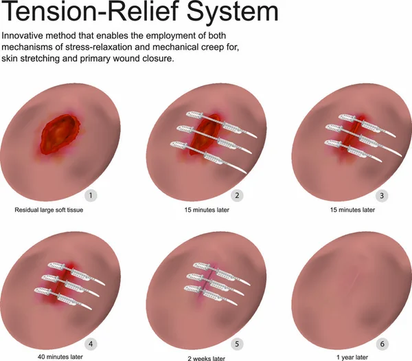 Система Снятия Напряжения Является Инновационным Методом Который Позволяет Использовать Механизмы — стоковый вектор