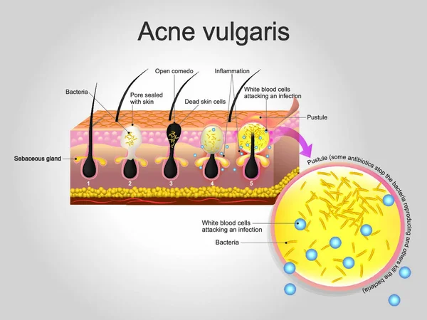 Acné Vulgar Una Enfermedad Piel Largo Plazo Que Produce Cuando — Vector de stock