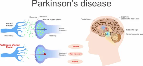 Уровень Дофамина Нормальной Пораженной Нейронах Паркинсона Графическая Иллюстрация — стоковый вектор