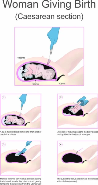 Cesárea Menudo Realiza Cuando Parto Vaginal Pondría Bebé Madre Riesgo — Vector de stock