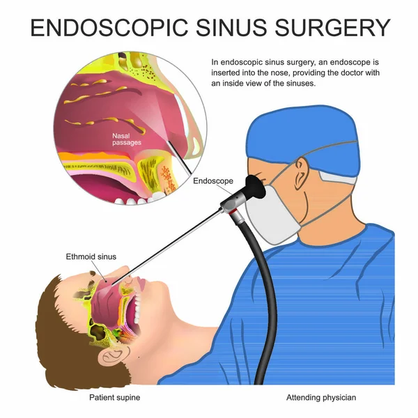 Endoscopic Sinus Surgery Endoscope Inserted Nose View Sinuses Illustration Anatomy — Stock Vector