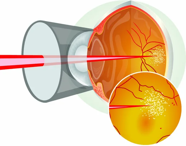 Cirugía Ocular Láser Cirugía Ocular Láser — Vector de stock