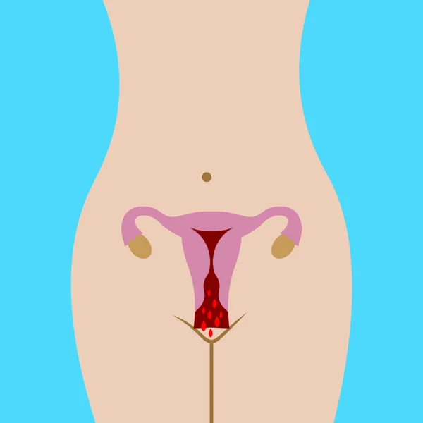 Menstruação Hemorragia Mensal Uma Mulher Fluxo Menstrual Figura Vetor Cuidados —  Vetores de Stock