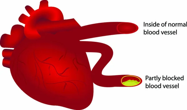 Corazón Con Vaso Sanguíneo Normal Parcialmente Bloqueado Ilustración Vectorial Sobre — Vector de stock
