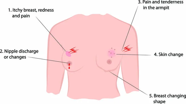 Síntomas Tempranos Del Cáncer Mama Infografía Ilusstración Vectorial — Vector de stock