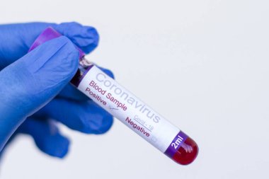 Eldivenli bir doktor koronavirüs için pozitif kan testi sonuçları tutuyor.