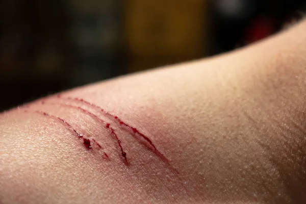 Herida fresca y sangrante en el hombro, de garras de gatos, después de juegos combinados y diversión . — Foto de Stock