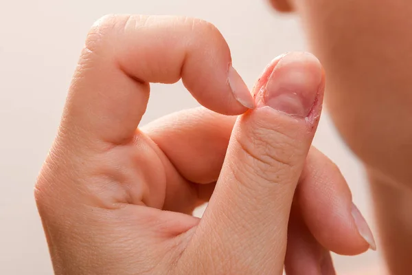 Dedo femenino lesionado después de morder las uñas — Foto de Stock