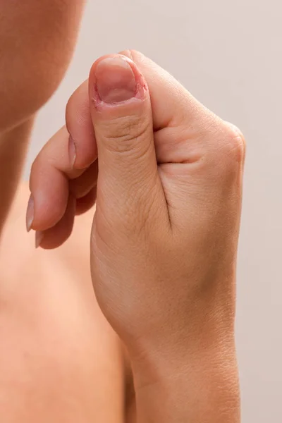 Skadet kvindelig finger efter bidende negle - Stock-foto