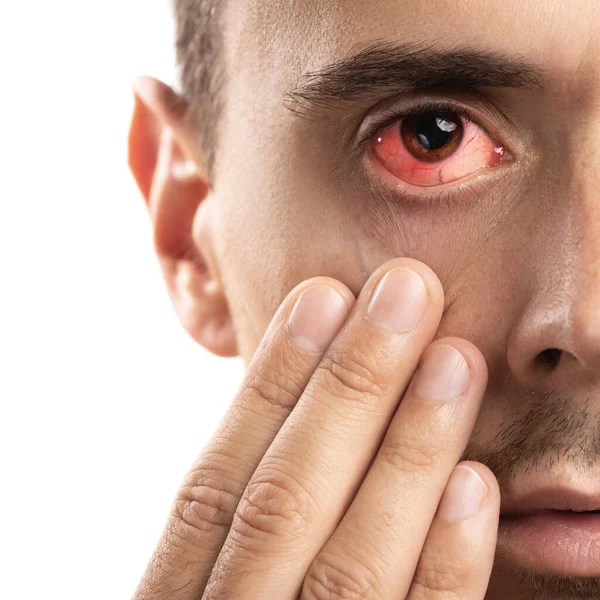 Broken Blood Vessel Eye Man Subconjunctival Hemorrhage — Stock Photo, Image