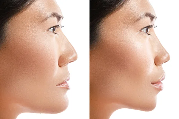 Transformación Mujer Asiática Resultado Cirugía Plástica Concepto Diferentes Modificaciones Con — Foto de Stock