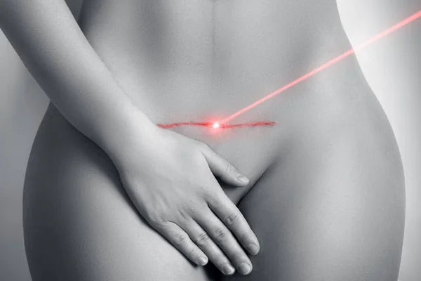 Traitement Laser Élimination Des Cicatrices Après Une Chirurgie Césarienne — Photo