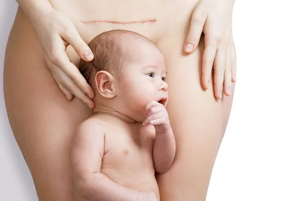Niedliches Kleines Neugeborenes Und Seine Mutter Mit Einer Narbe Nach — Stockfoto