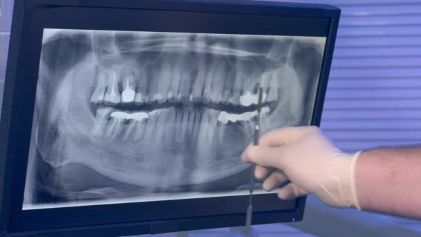 Röntgen panorámakép a fogak és a fogorvosok kéz eszközzel mozogjon a képernyőn