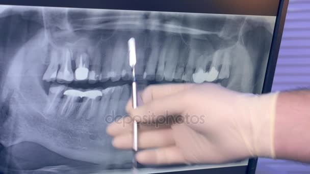 Radiografía panorámica de los dientes en el monitor y los médicos entregan el guante con la herramienta — Vídeo de stock