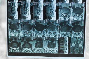 Bacak ve kalça röntgenleri.