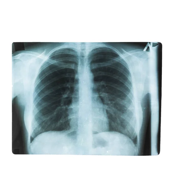Sağlıklı Akciğerlerin Röntgeni Nsan Kemikleri — Stok fotoğraf