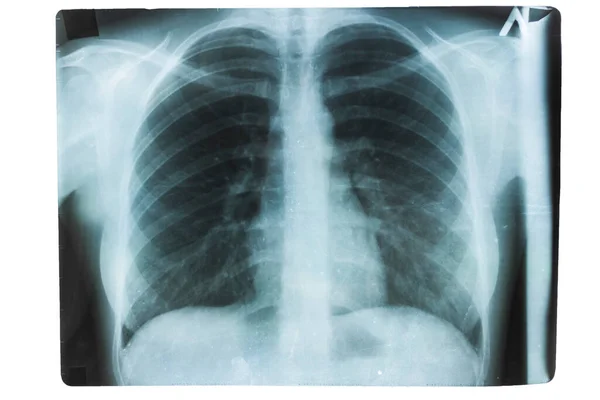 Ray Healthy Lungs Human Bones — Stock Photo, Image