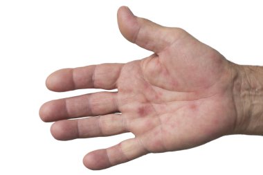el, ayak ve ağız hastalığı