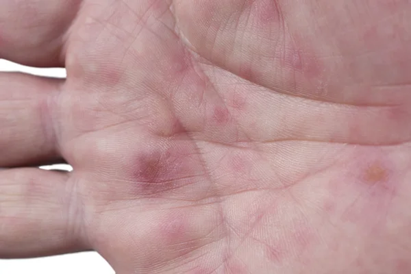 Hand, foot and mouth disease — Stock Photo, Image