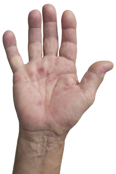Doença da mão, pé e boca — Fotografia de Stock