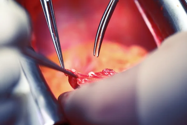 Manos operativas de médicos, cirugía cardíaca — Foto de Stock
